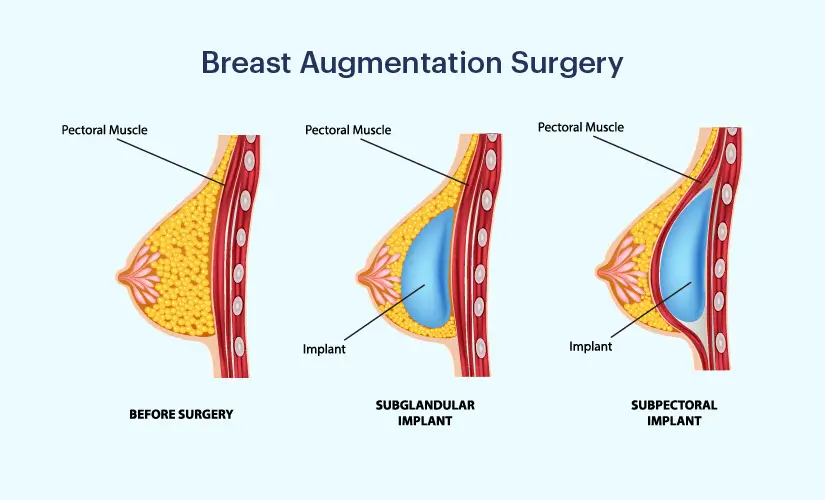 Breast Augmentation